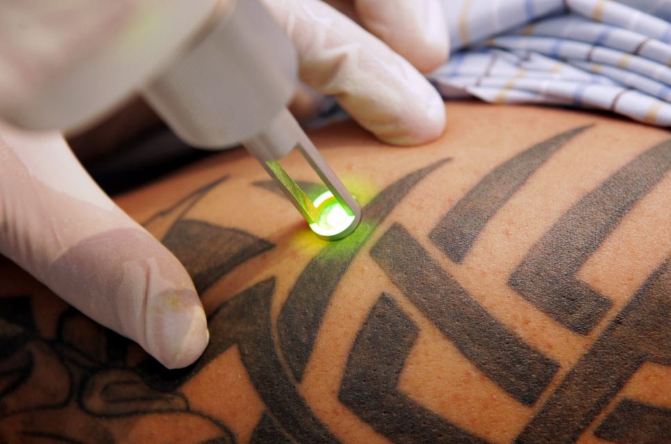 Tetoválás eltávolítás lézerrel